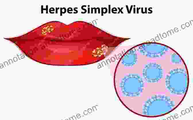 Anatomical Representation Of Herpes HSV2 Herpes (HSV2) : What Doctors Won T Tell You