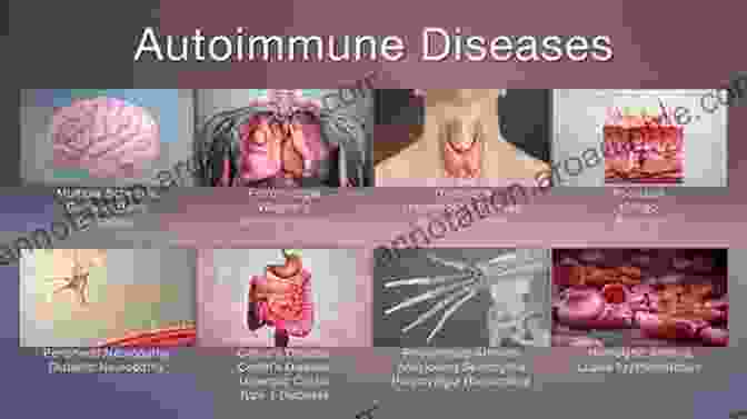 Autoimmune Diseases: Immune System's Misguided Attack Immunity And Infection Zevedei Barbu