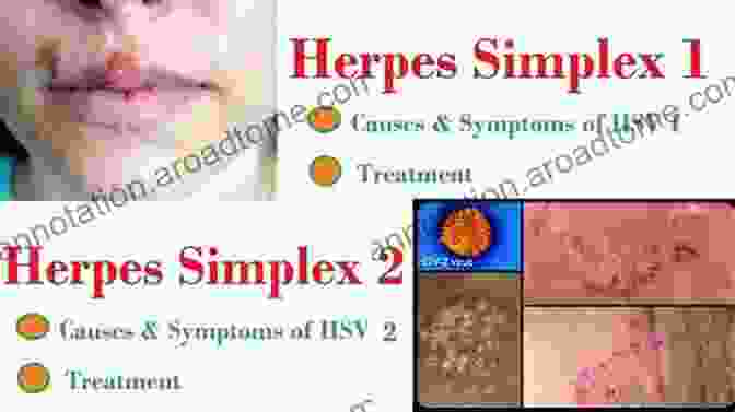 Personal Experiences With Herpes HSV2 Herpes (HSV2) : What Doctors Won T Tell You