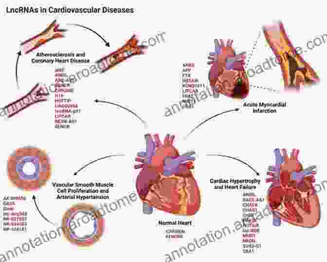 Stunning Netter Illustration Depicting The Pathology Of A Heart Attack Netter S Illustrated Human Pathology Updated Edition E Book: With Student Consult Access